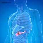 Batu Empedu Bisa Sebabkan Pankreatitis, Kok Bisa?