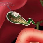 Apa Itu Polip Empedu? Kenali Penyebab dan Risikonya