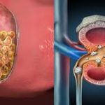 Batu Empedu dalam Kandung Empedu: Proses Terbentuk, Faktor Risiko, dan Dampaknya pada Kesehatan