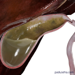 Peran Cairan Empedu dalam Terbentuknya Batu Empedu