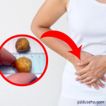 Bagaimana Proses Terbentuknya Batu Empedu di Dalam Tubuh?