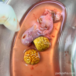 Batu Empedu dan Risiko Peradangan Kantung Empedu