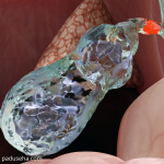 Memahami Batu Empedu untuk Mencegah Komplikasi