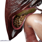 Batu Empedu Tersangkut di Saluran Empedu, Ini Dampaknya